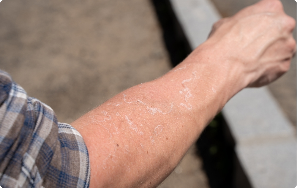 Kā eļļa kairinātai un sausai ādai